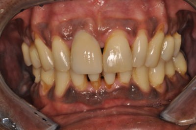 Close up of a mouth that has gum disease