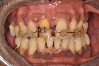Close up of a mouth with braces that has gum disease
