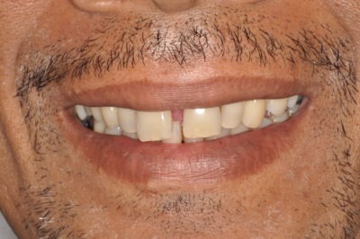 Close up of the mouth of a brunette adult before his dental treatment