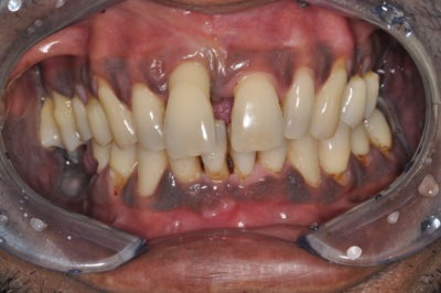 Close up of a mouth that has gum disease