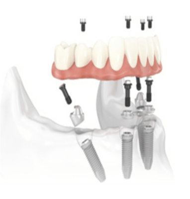 All-on-4 Dental Implant Illustration