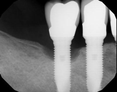 Dental x-ray
