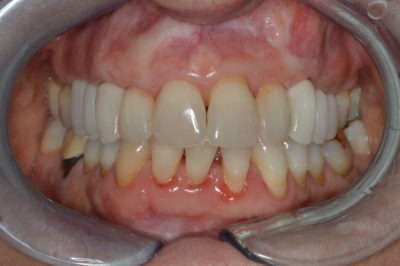 Close up of a mouth before a dental treatment