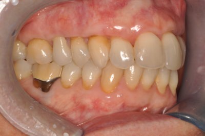 Close up of a mouth before a dental treatment