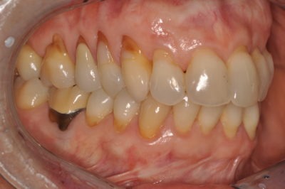 Close up of a mouth before a dental treatment