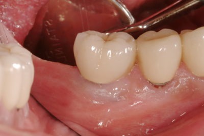 Close up photo of a pair of teeth and gums during a dental checkup