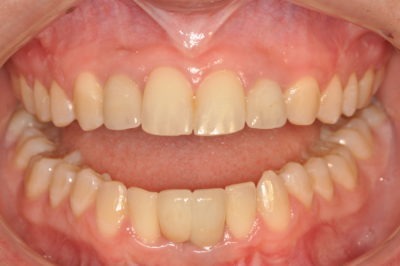 Close up photo of a mouth and teeth