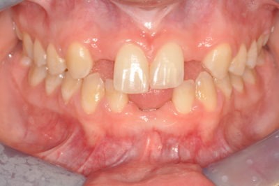 Close up photo of a mouth and teeth