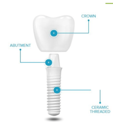 Descriptive illustration of how dental implants are composed