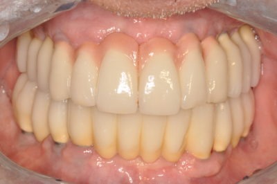 Close up of a mouth, where a dental implant treatment is visualized