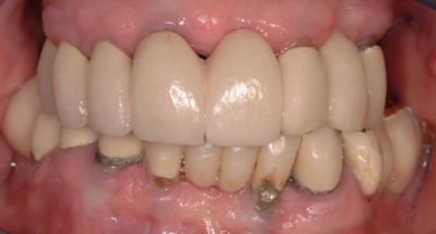 Close up of a mouth where noticeable wear is observed
