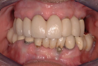 Close up of a mouth where noticeable wear is observed
