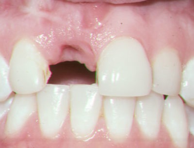 Close up of a mouth where the absence of a tooth stands out