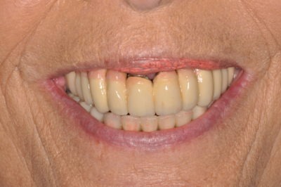Close up of a patient's smile before a dental treatment