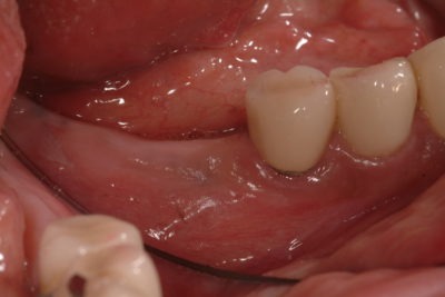 Close up of a mouth and teeth before a dental treatment