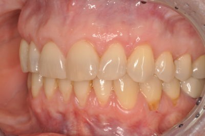 Close up of a mouth after a dental treatment