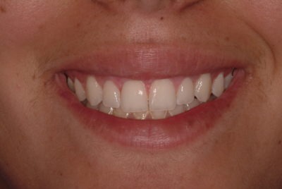 Close up of a mouth after a dental treatment