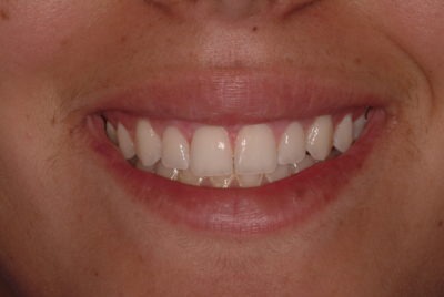 Close up of a mouth after a dental treatment