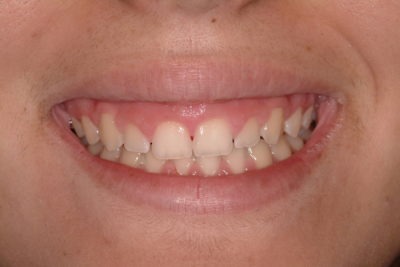 Close up of a mouth before a dental treatment