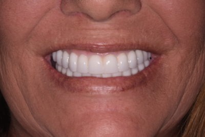 Smile of a lady after undergoing a teeth whitening treatment