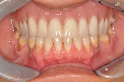 Close up of some teeth after dental treatment