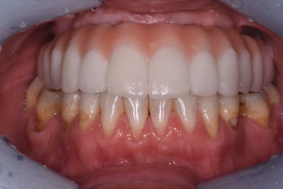 Close up of a mouth, where implants are visible in the upper part