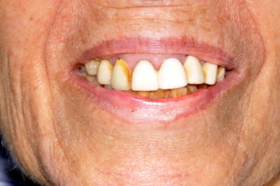 Close up photo of teeth before a dental cleaning