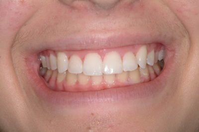 Close up of a mouth after teeth whitening