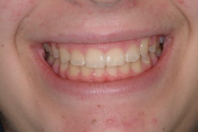 Close up of a mouth before teeth whitening treatment