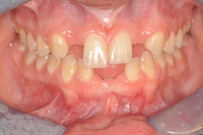 Close up of a mouth and teeth before a dental treatment