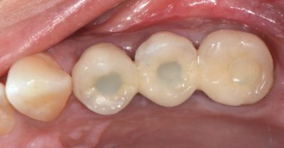 Close up of 4 teeth after a dental root canal treatment