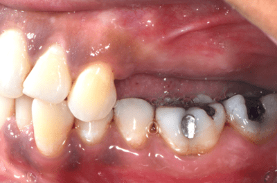 Close up of a mouth where 2 teeth with resins stand out at the bottom