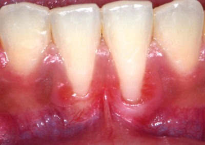 Close up 4 teeth from the bottom after a dental treatment