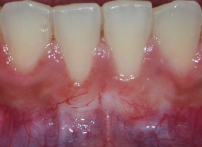 Close up 4 teeth from the bottom after a dental treatment