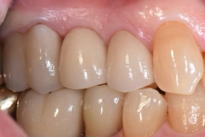 Three upper teeth restored with ceramic crowns with the middle one supported by a zirconia implant