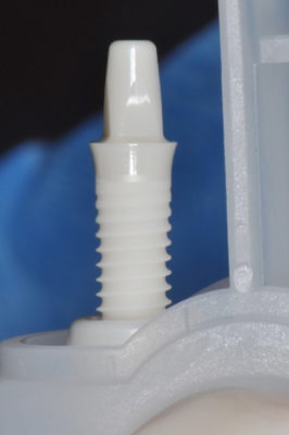 Photo of a dental implant