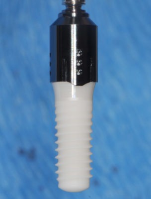 Photo of a dental implant