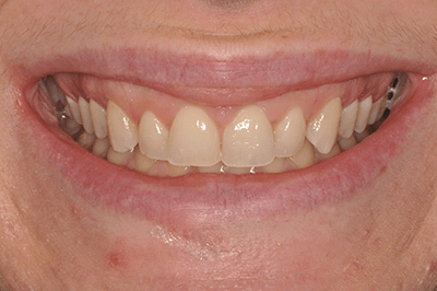 Close up photo of a mouth and teeth of a young white woman
