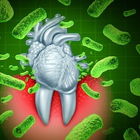 periodontitis gum disease graphic