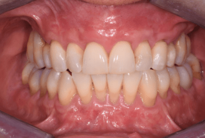 Close up of a mouth after dental treatment