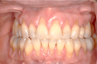 Close up of a mouth before dental treatment
