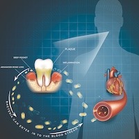 Illustration about Gum Disease Inflammation Bacteria Can Enter In To The Blood Stream An Affect Heart